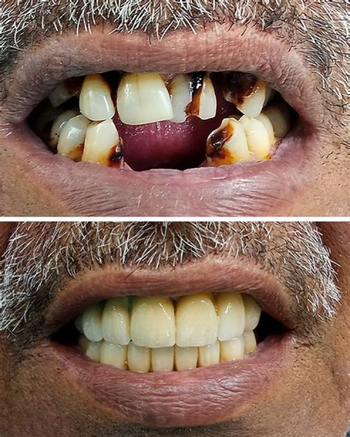 See Dental Makeover Photos – Hollywood Life